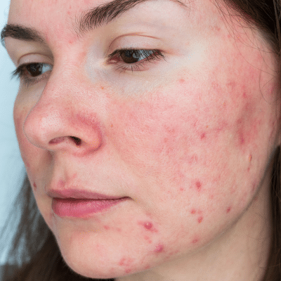 Closeup of woman's face with rosacea, representing rosacea treatment options